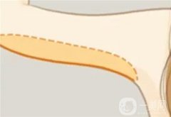 什么因素決定手臂吸脂的價(jià)格？