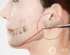 為什么下頜角不好看？介紹五種類(lèi)型看看你是不是