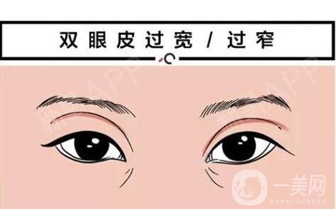 全切雙眼皮的眼部整形手術(shù)*果是*嗎