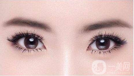 男生割雙眼皮自然嗎 割雙眼皮多少錢呢