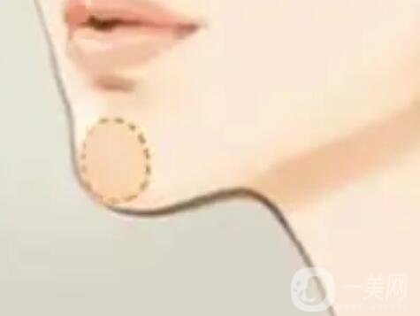 墊下巴能改變顴骨臉型么