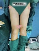 自從在醫(yī)院做了大腿吸脂手術(shù)以后，我終于擁有了兩條纖細(xì)筆直的漫畫腿