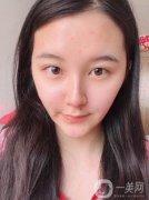 在整個過程中不會感覺到什么疼痛，現(xiàn)在熱瑪吉已經(jīng)發(fā)展到第五代了