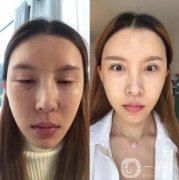 聽老朋友的話以后，我也覺得這個熱瑪吉手術(shù)挺好的，就想去試試