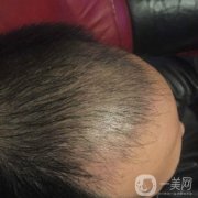 而我也是在這個(gè)時(shí)候出現(xiàn)的嚴(yán)重脫發(fā)，而且我覺得自己的情況要比當(dāng)初的爸爸更