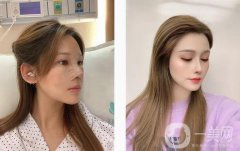 想了很久，攢了很久的錢，終于如愿在醫(yī)院做了個(gè)鼻子