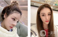 現(xiàn)在鼻子弧度還是很好的，山根自然消失，在原來的基礎(chǔ)上增加1 mm以上