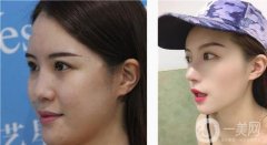 鼻子很別扭，首先我的鼻孔不對稱，鼻梁還很低