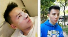 來醫(yī)院面診后，醫(yī)生給我做鼻子合成的建議，腫脹的耳軟骨墊托起了鼻子鼻頭縮