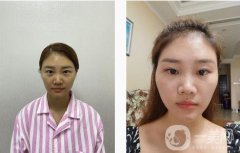 埋線雙眼皮手術(shù)后，我覺得每天照鏡子成了我不可或缺的例行公事