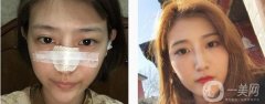 所以很多人對自己的鼻子不滿意，甚至有人選擇做隆鼻來達(dá)到美觀的效果