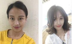 鼻子本身不太好看，一直想做鼻子，但是因為是個很糾結的人，一直糾結