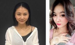 比如我的鼻子，我的鼻子，我的鼻梁都比較低，但是從正面看沒有問題，但是從