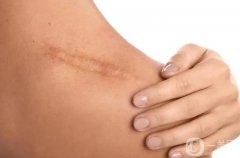 阿嬌傷勢(shì)恢復(fù)，淡化疤痕有妙招!從成因找方法，讓疤痕無(wú)跡可痕