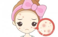 痘痘肌的福音!揭秘致痘成分，讓你遠離痘痘困擾