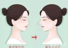 張軍醫(yī)生隆鼻案例分享，專家資料介紹、價(jià)格收費(fèi)標(biāo)準(zhǔn)一覽