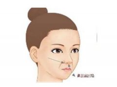 隆鼻后鼻梁發(fā)紅的原因有哪些