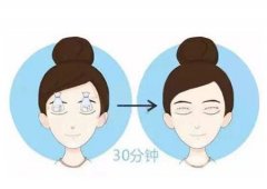 埋線雙眼皮手術(shù)適合哪些人群？