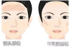 面部抽脂后面部會不會凹陷