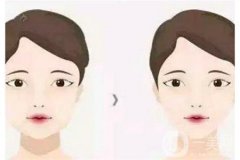 面部吸脂手術前后的注意事項