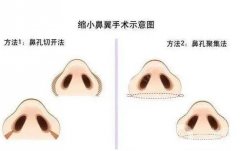 哪些情況下適合進(jìn)行鼻孔縮小術(shù)