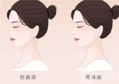 膨體隆鼻修復(fù)的佳時(shí)間