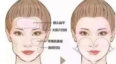 切眉術(shù)后的護理與注意事項