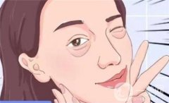 祛除眼袋手術(shù)后多久可以拆線