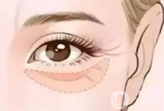 去除眼袋術(shù)后的注意事項(xiàng)有哪些