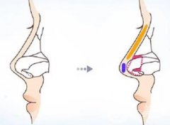 如何應對膨體隆鼻后的效果不理想？