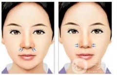 如何預防隆鼻假體取出后留下疤痕？