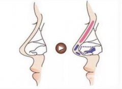 鼻頭縮小手術(shù)的優(yōu)勢及是否會反彈