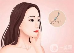 鼻綜合有后遺癥嗎？要注意哪些事項(xiàng)